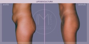 Before and after pictures of a liposculpture procedure